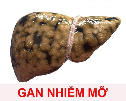 hinh-anh-la-gan-o-benh-nhan-bi-gan-nhiem-mo.jpg