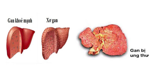 Triệu chứng của bệnh xơ gan do rượu là gì? Câu trả lời có ở đây!