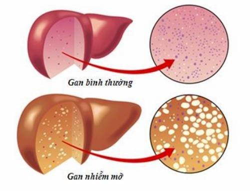  Gan nhiễm mỡ tình trạng lượng mỡ trong gan chiếm hơn 5% trong lượng của cơ quan này