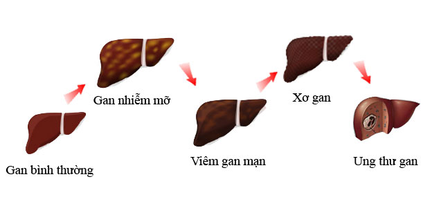 gan-nhiem-mo-khong-duoc-phat-hien-va-dieu-tri-dung-cach-co-the-gay-xo-gan-ung-thu-gan.png