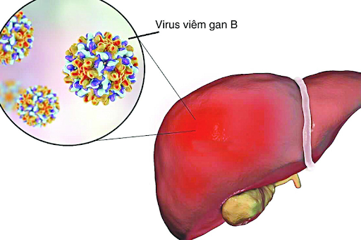  Những điều cần biết về căn bệnh viêm gan B