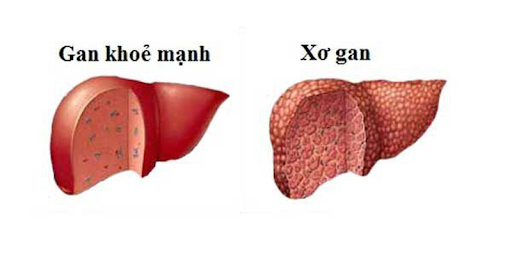 Giải đáp thắc mắc: BỆNH XƠ GAN CÓ NGUY HIỂM KHÔNG? - Câu trả lời có ở đây!