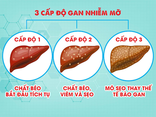 gan-nhiem-mo-do-3-la-cap-do-nguy-hiem.png