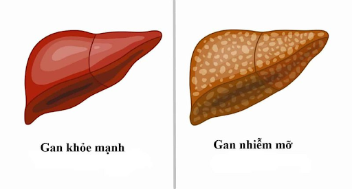 Bạn có biết: CÁCH ĐIỀU TRỊ GAN NHIỄM MỠ ĐỘ 2 là gì không?