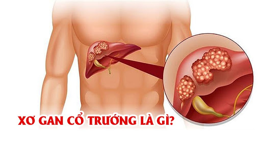 Xơ gan cổ trướng: Nguyên nhân và cách điều trị hiệu quả. Xem ngay!