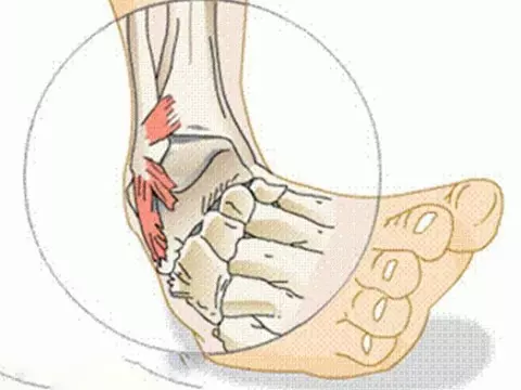 Lật cổ chân là chấn thương thể thao thường gặp do bị té ngã 
