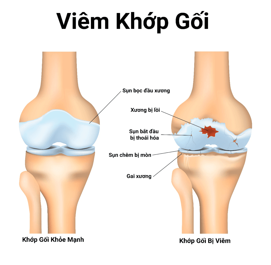 viem-khop-goi-gay-ra-trieu-chung-dau-dau-goi-khi-dung-len-ngoi-xuong.png