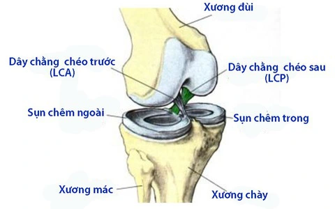 Đứt dây chằng chéo rách sụn chêm là chấn thương khi dây chằng chéo và sụn chêm bị rách, vỡ cùng một lúc