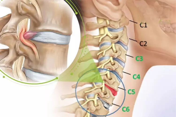 Cảnh giác với các bệnh lý gây ra tiếng kêu lục cục ở cổ và vai 