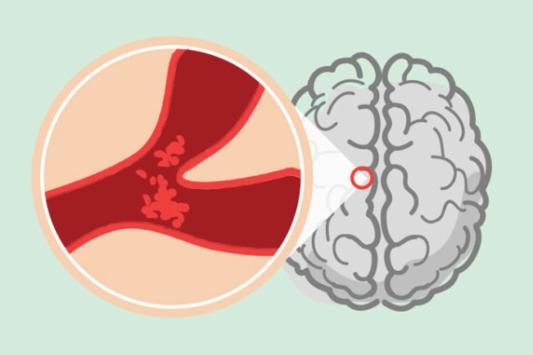 Thiếu máu não là dấu hiệu cảnh báo đột quỵ não có thể xảy ra