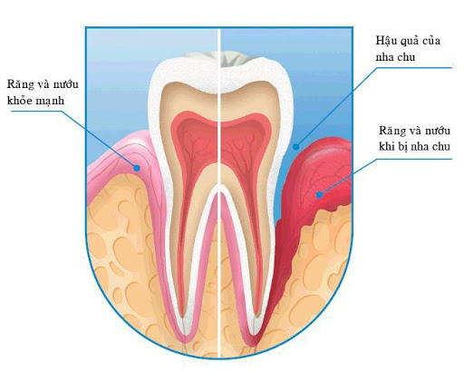Triệu chứng điển hình của bệnh viêm quanh răng