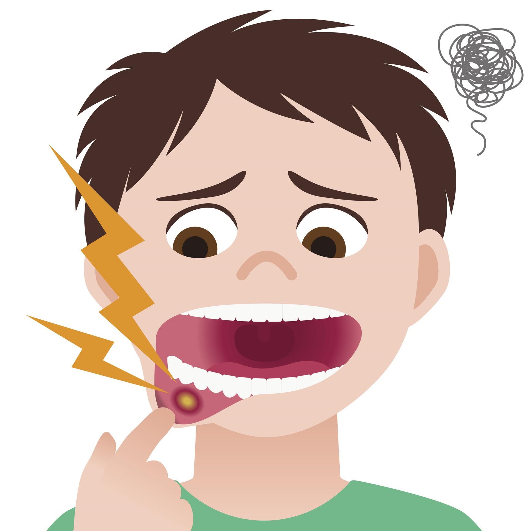 Nhiệt miệng khiến bệnh nhân đau đớn
