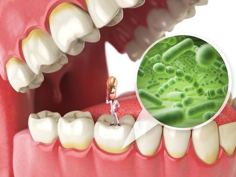 Các vi khuẩn có trong mảng bám là nguyên nhân chính gây viêm chân răng