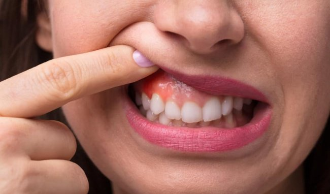 Viêm chân răng xuất hiện với tình trạng sưng tấy các tổ chức quanh răng