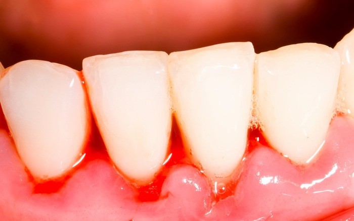 Chảy máu chân răng thường xuyên là bệnh gì? Cách điều trị an toàn, hiệu quả?