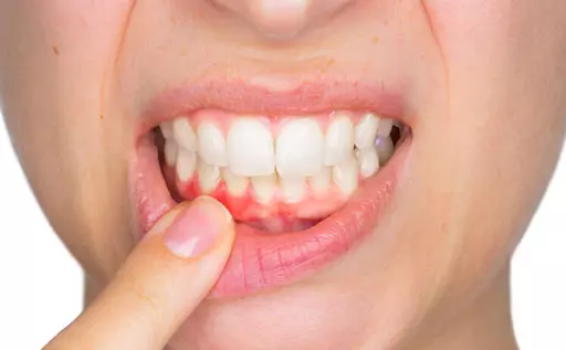 Cẩn trọng tình trạng đau nướu răng không thể chủ quan
