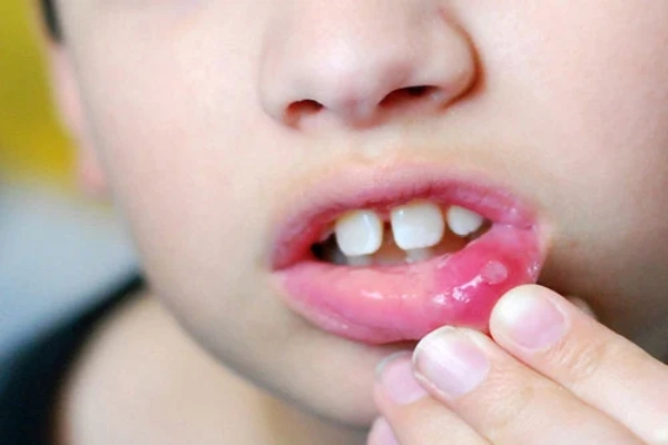 Nguyên nhân nhiệt miệng ở trẻ bao gồm: giảm miễn dịch, virus và vi khuẩn tấn công, tổn thương niêm mạc,...