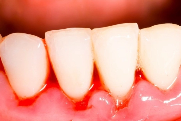 Chảy máu chân răng thường xuyên là bệnh gì? Cách điều trị an toàn, hiệu quả?