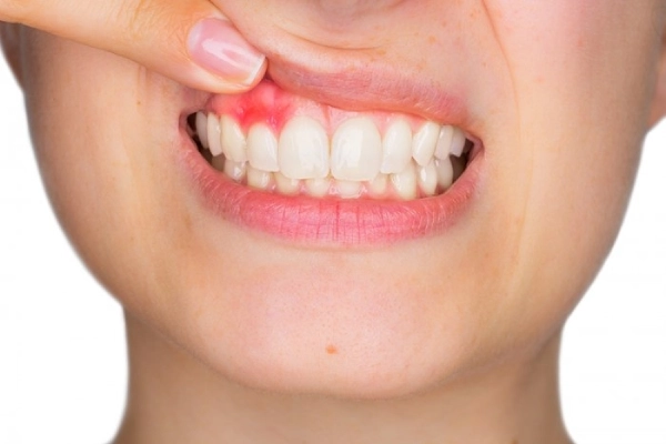 Chảy máu chân răng là dấu hiệu của bệnh viêm lợi, viêm nha chu