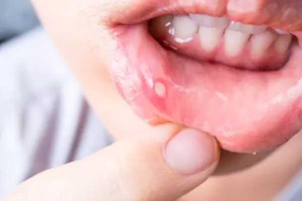 Hiểu về nhiệt miệng: Nguyên nhân, dấu hiệu và cách điều trị