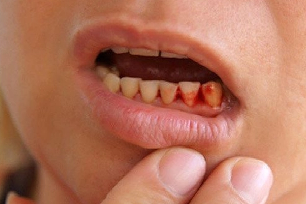 Chảy máu chân răng ở trẻ em phải làm sao? Cách khắc phục hiệu quả nhờ sử dụng sản phẩm từ thiên nhiên! CLICK XEM NGAY