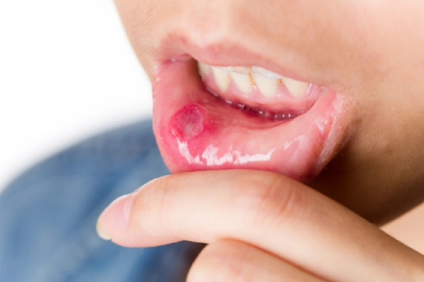 Triệu chứng điển hình của loét miệng áp tơ