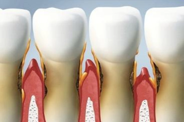 Triệu chứng viêm chân răng