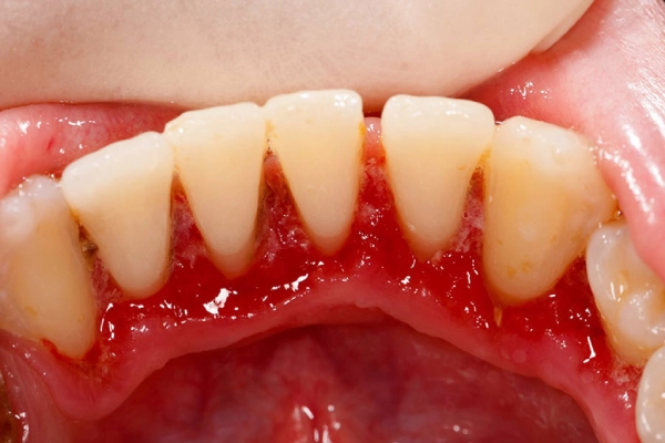 Vi khuẩn,virus là nguyên nhân gây viêm nướu răng