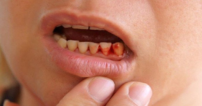 Chảy máu chân răng ở trẻ em phải làm sao? Cách khắc phục hiệu quả nhờ sử dụng sản phẩm từ thiên nhiên! CLICK XEM NGAY