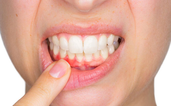 Viêm nướu răng: Tổng hợp các thông tin chi tiết nhất