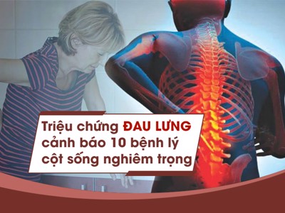 Triệu chứng đau lưng cảnh báo 10 bệnh lý cột sống nghiêm trọng