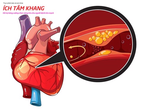 Thiếu máu cơ tim là gì? Nguyên nhân, hậu quả và cách chữa hiệu quả