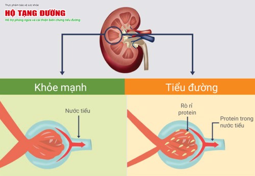 Biến chứng thận của bệnh tiểu đường - Thông tin từ A-Z