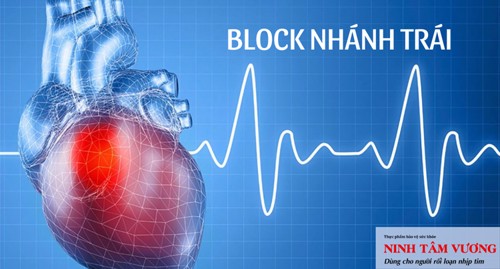 Block nhánh trái ở tim: Nguyên nhân, dấu hiệu và cách điều trị