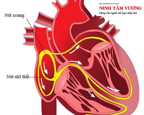 Tìm hiểu hội chứng nút xoang tim & cách điều trị