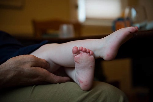 Trẻ bị nổi mụn nước ở lòng bàn chân là biểu hiện của bệnh gì? Xem ngay