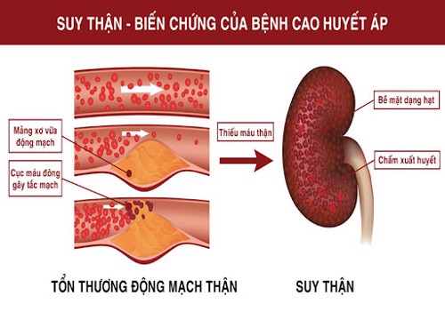 Các phương pháp điều trị suy thận mạn hiệu quả cao hiện nay